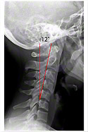 Neck X-ray (Cervical X-ray) - After Chiropractic Treatment - Noticable Improvement in Abnormal Curve