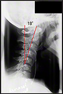 Neck X-ray (Cervical X-ray) - Before Chiropractic Treatment - Reverse Neck Curve (Reverse Lordosis)